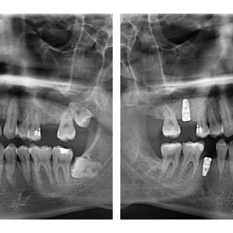 imgi_3_panoramik-rontgen-implant
